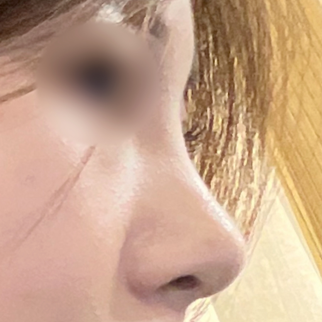 코성형 후 사진 3