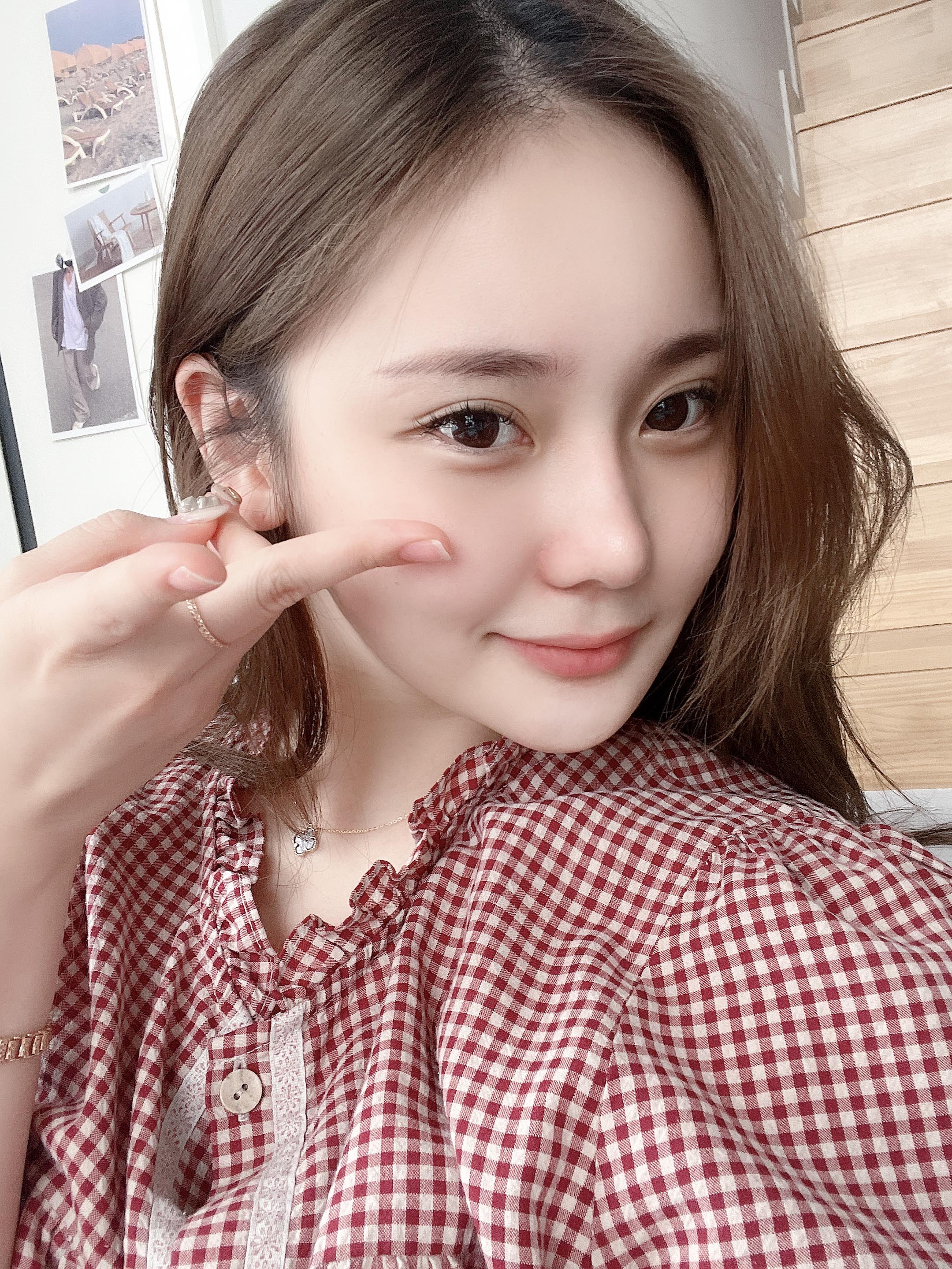 코성형 후 사진 2