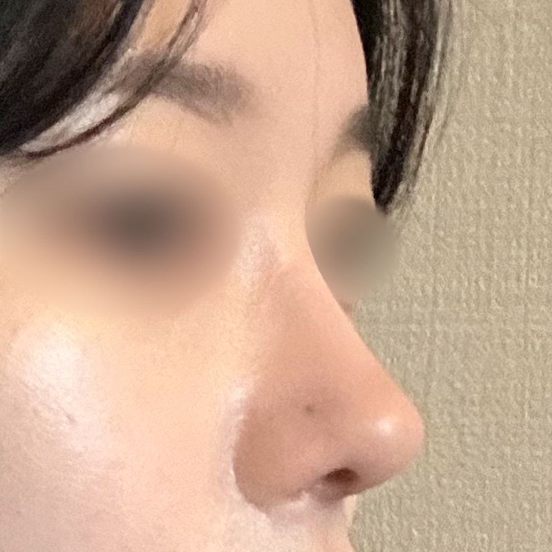 코성형 후 사진 4