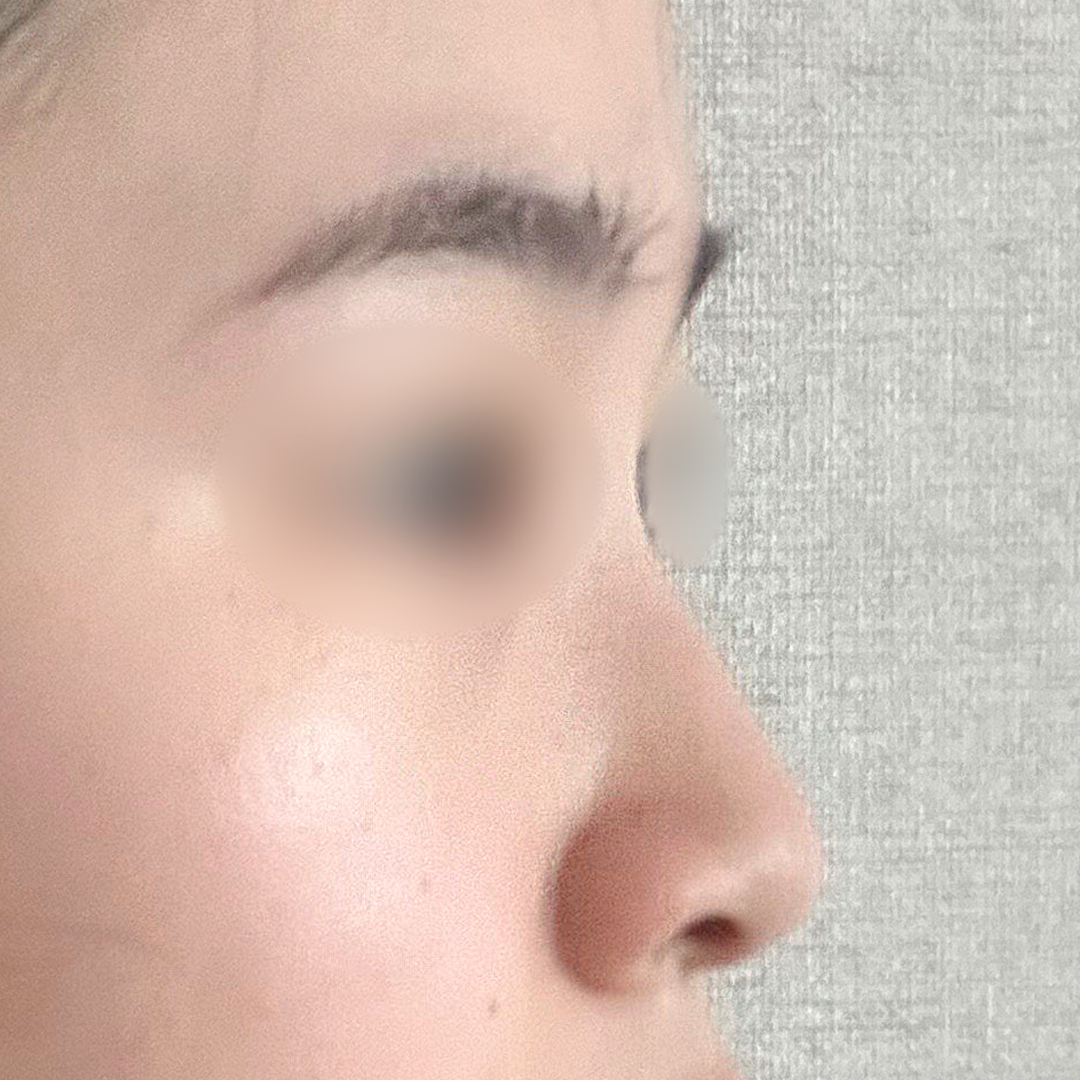 코성형 전 사진 5