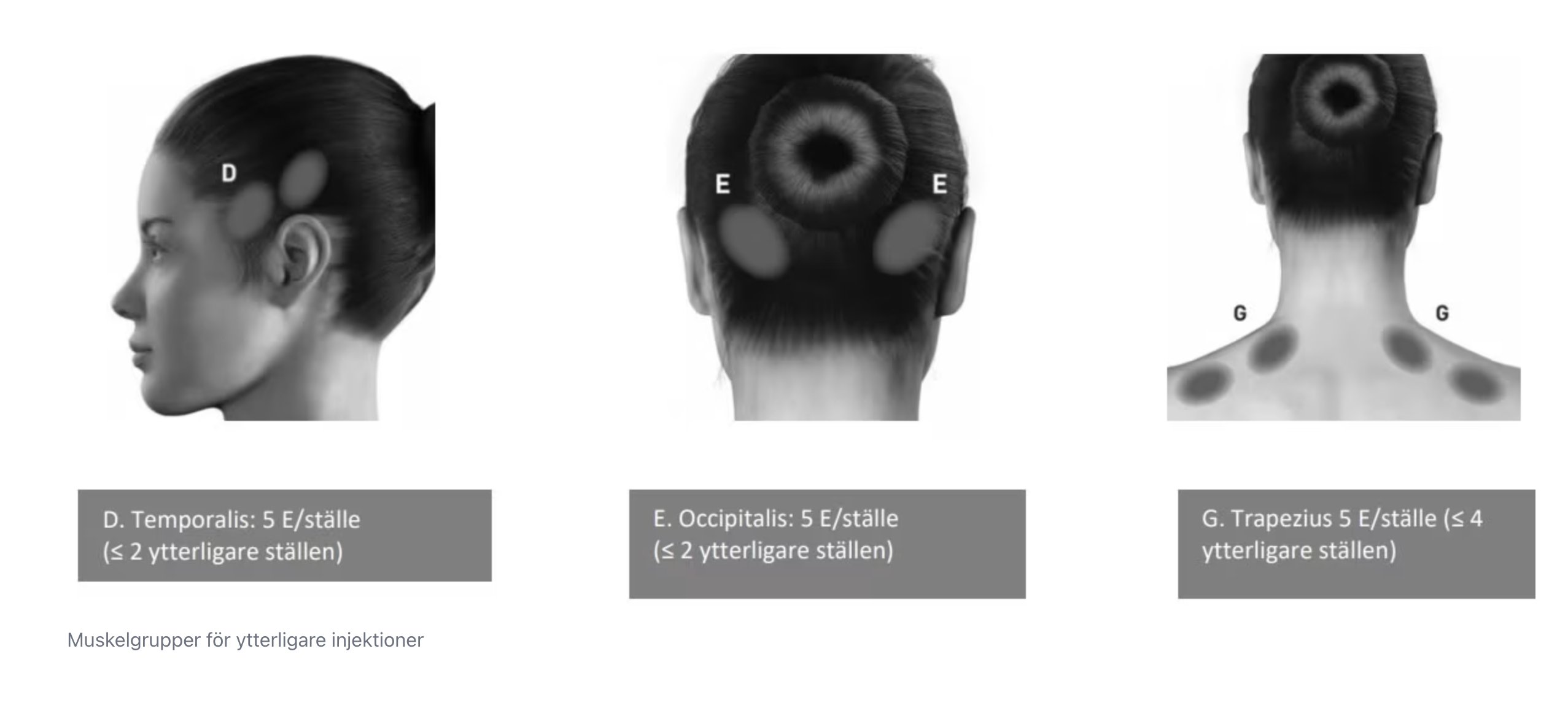 PREEMPT-protokollet – dosering och muskelgrupper
