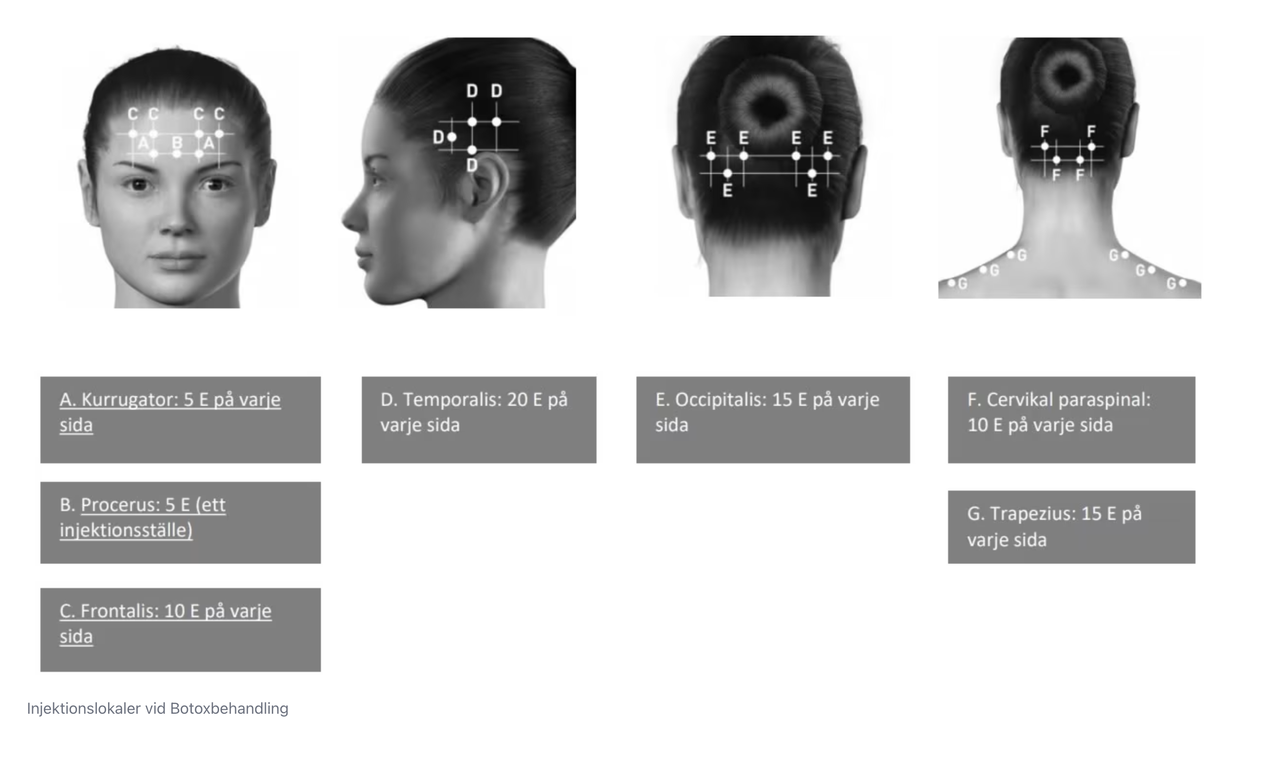 PREEMPT-protokollet – injektionspunkter kronisk migrän