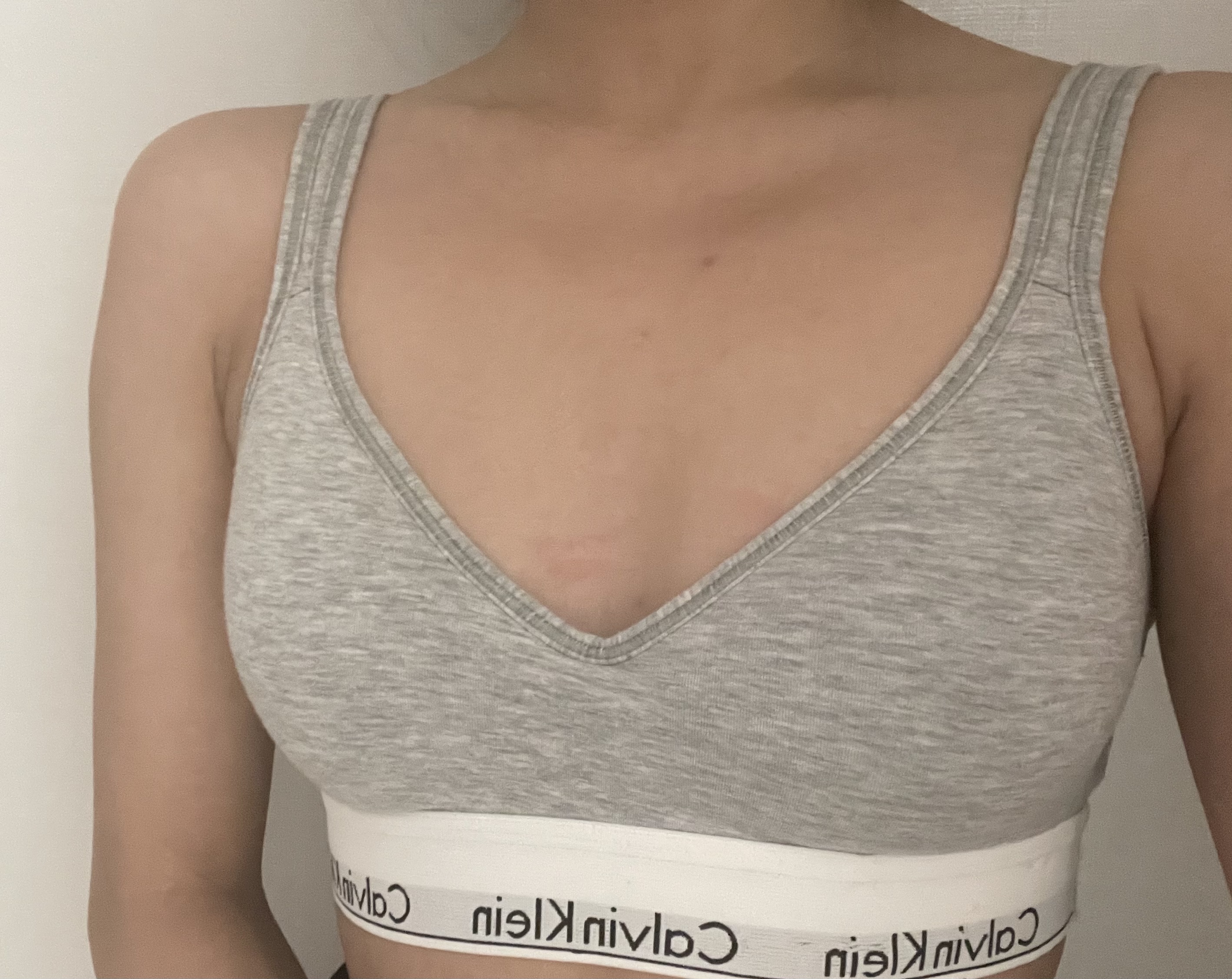 멘토 가슴성형 Before