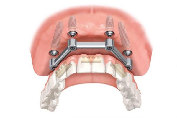 Klikgebit implantaat prothese