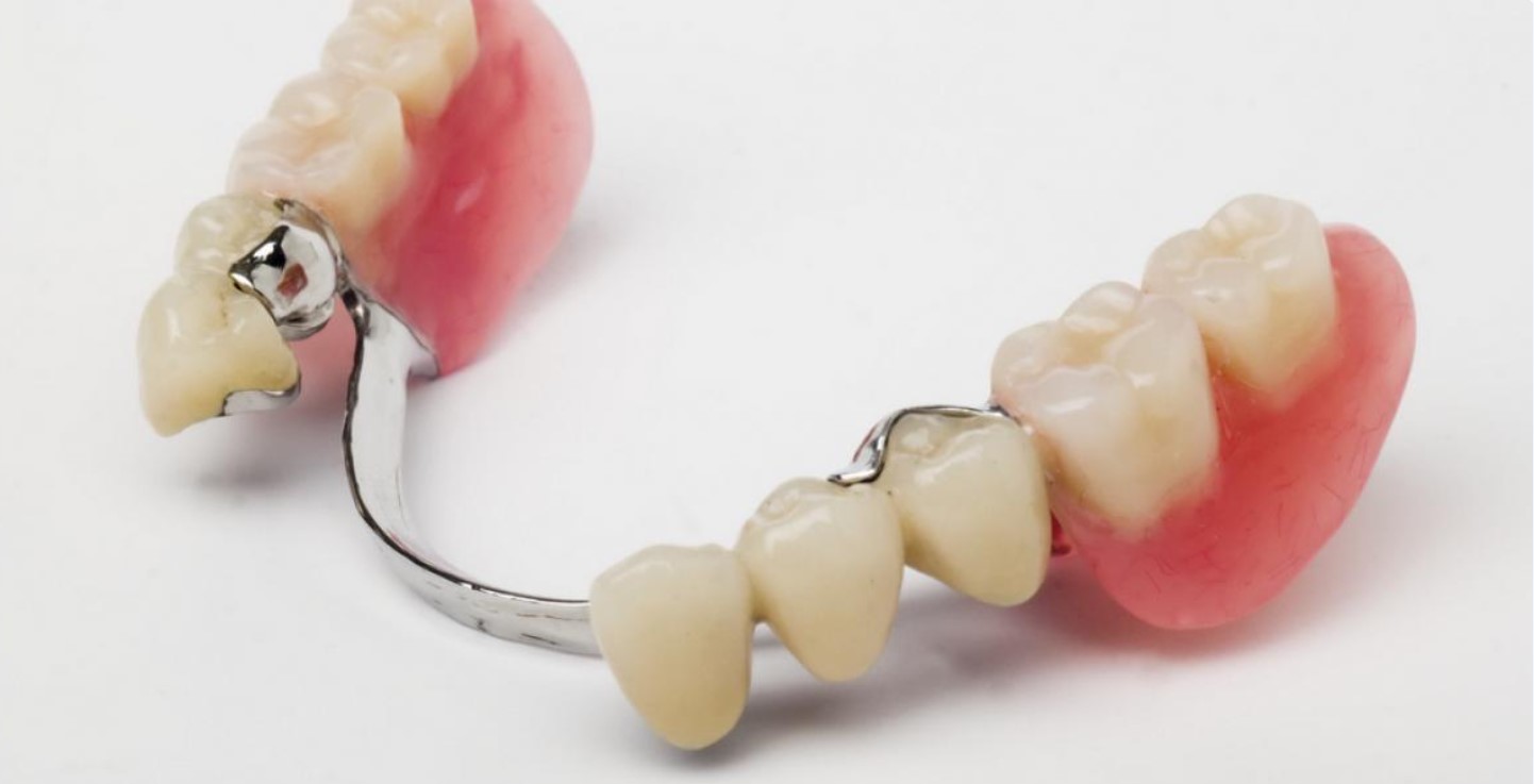 Frame systeem tandtechniek