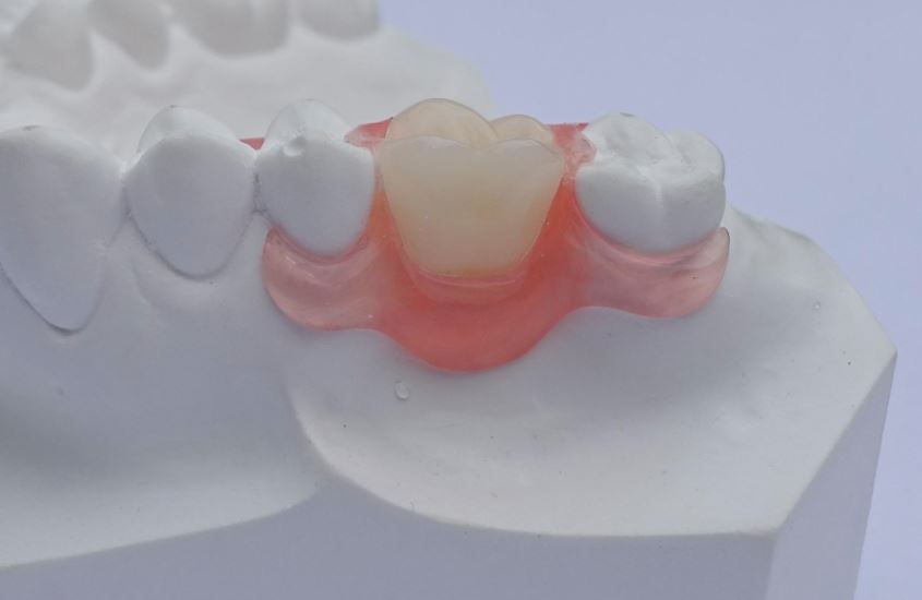 Flex gedeeltelijke prothese