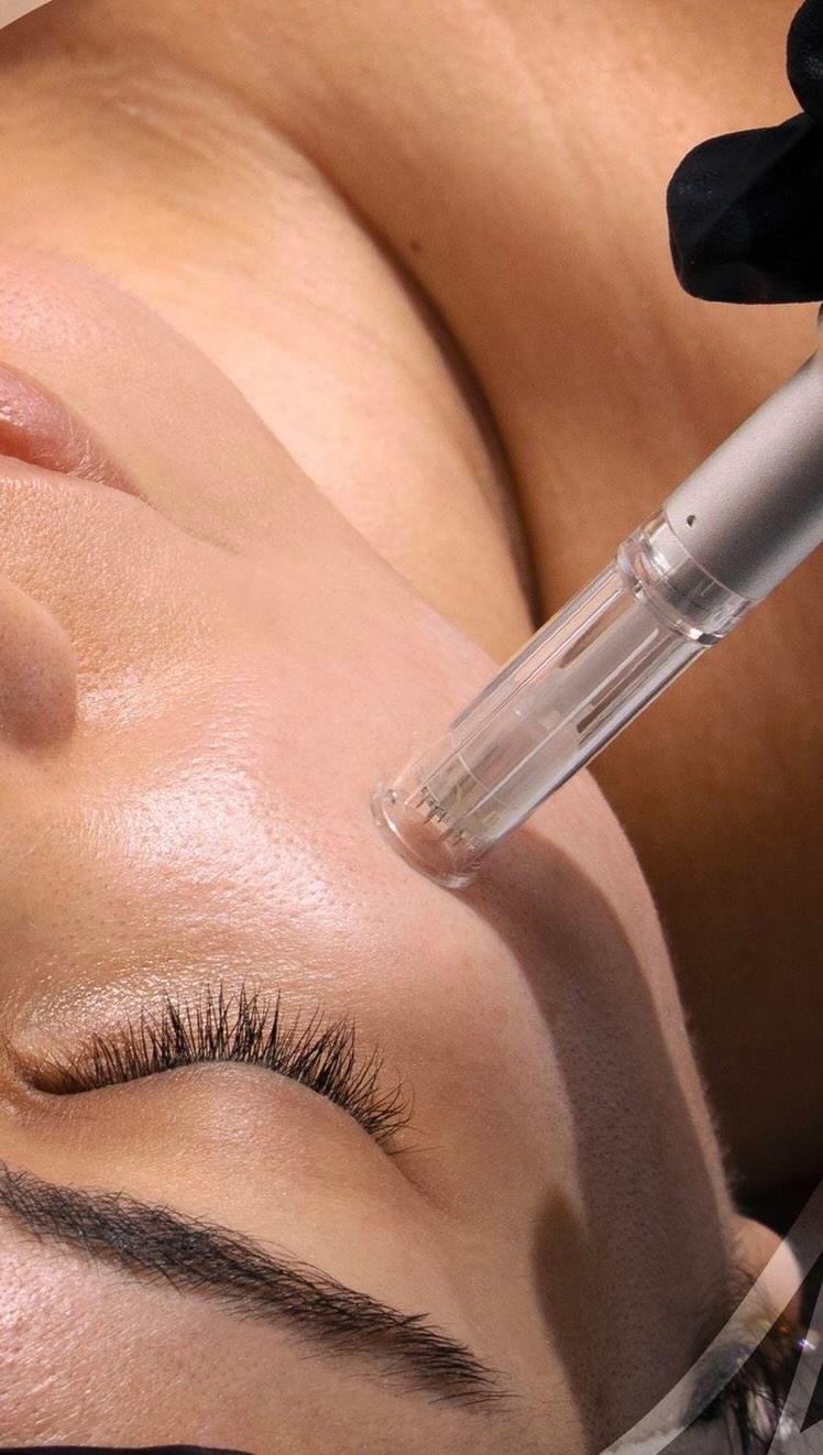 Microneedling