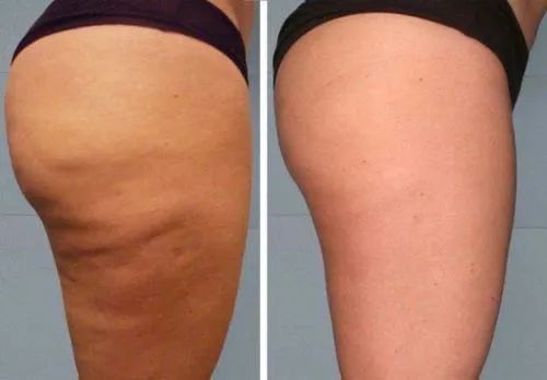 Cellulite-Behandlung