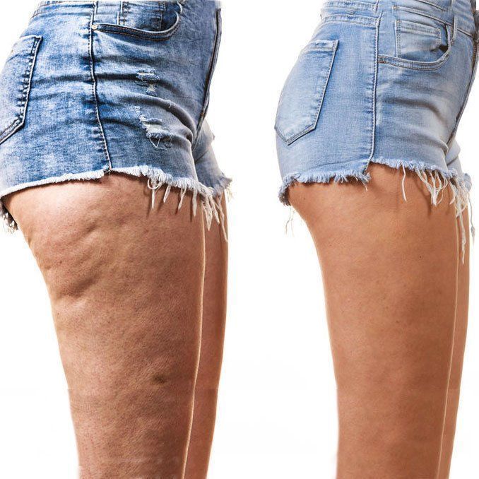Cellulite-Behandlung
