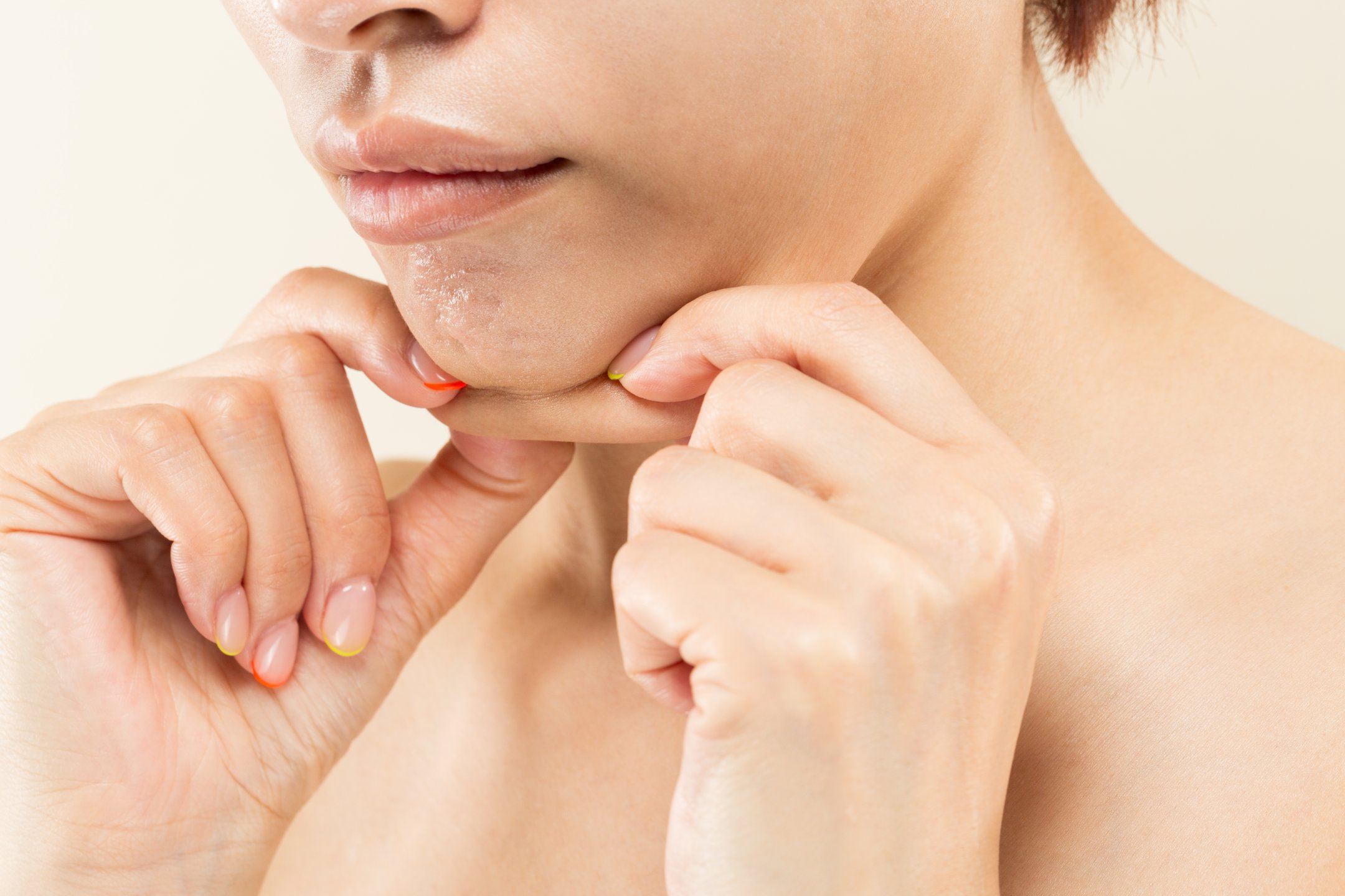 Neurotoxin treatment