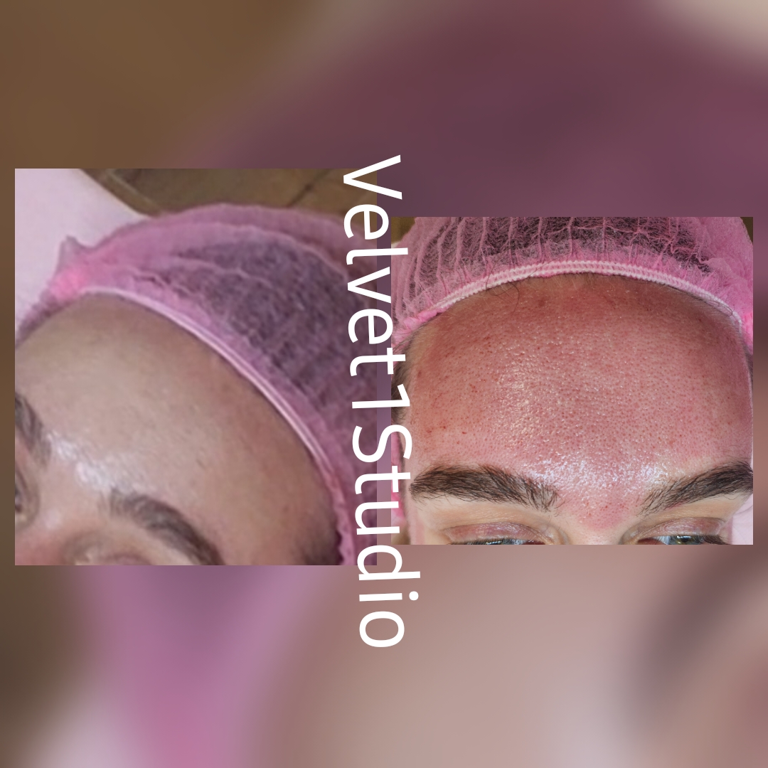 Rezultat tratament profesional — piele curată și luminată la Velvet 1 Studio