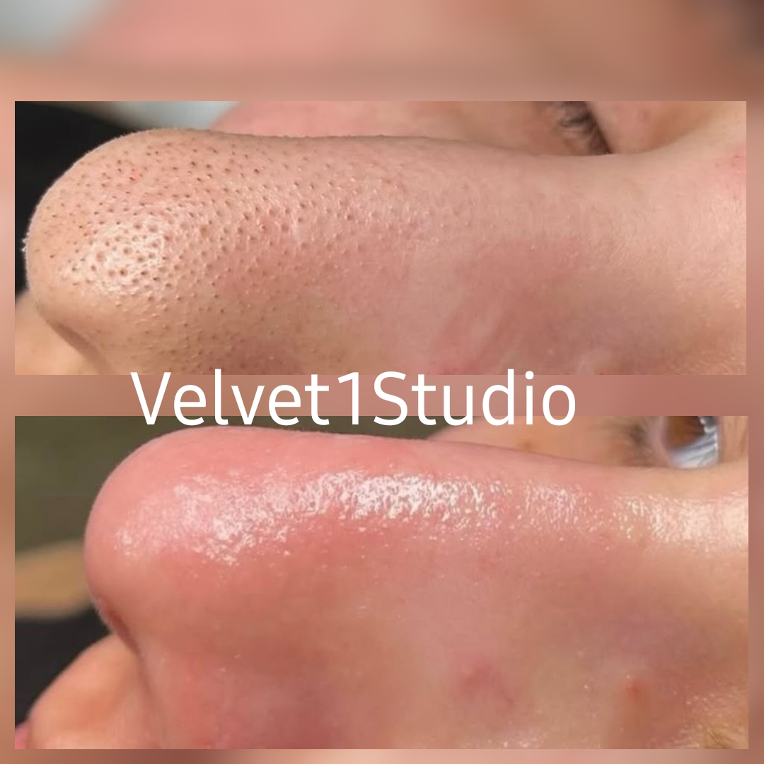 Rezultat epilare cu laser — piele fără păr și rejuvenată la Velvet 1 Studio