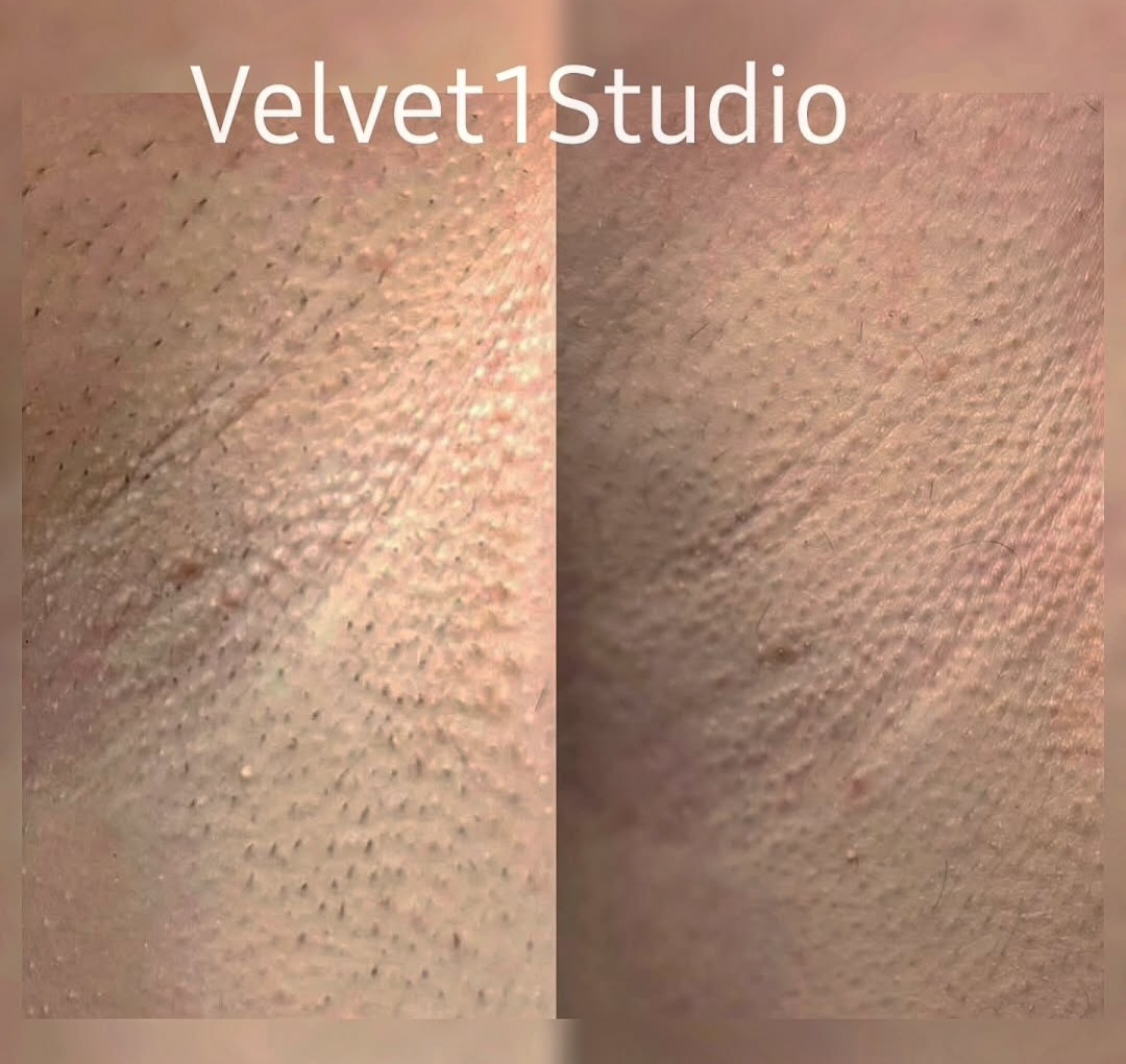 Rezultat tratament epilare definitivă — piele fină și netedă la Velvet 1 Studio