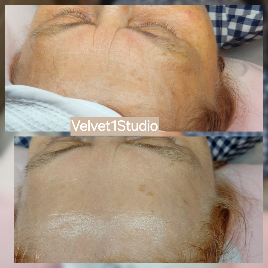 Rezultat tratament profesional — piele rejuvenată și radiantă la Velvet 1 Studio