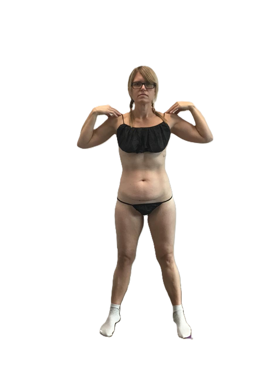Abdominoplasty before