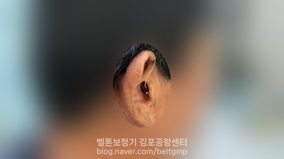 오픈형+청능재활 후기