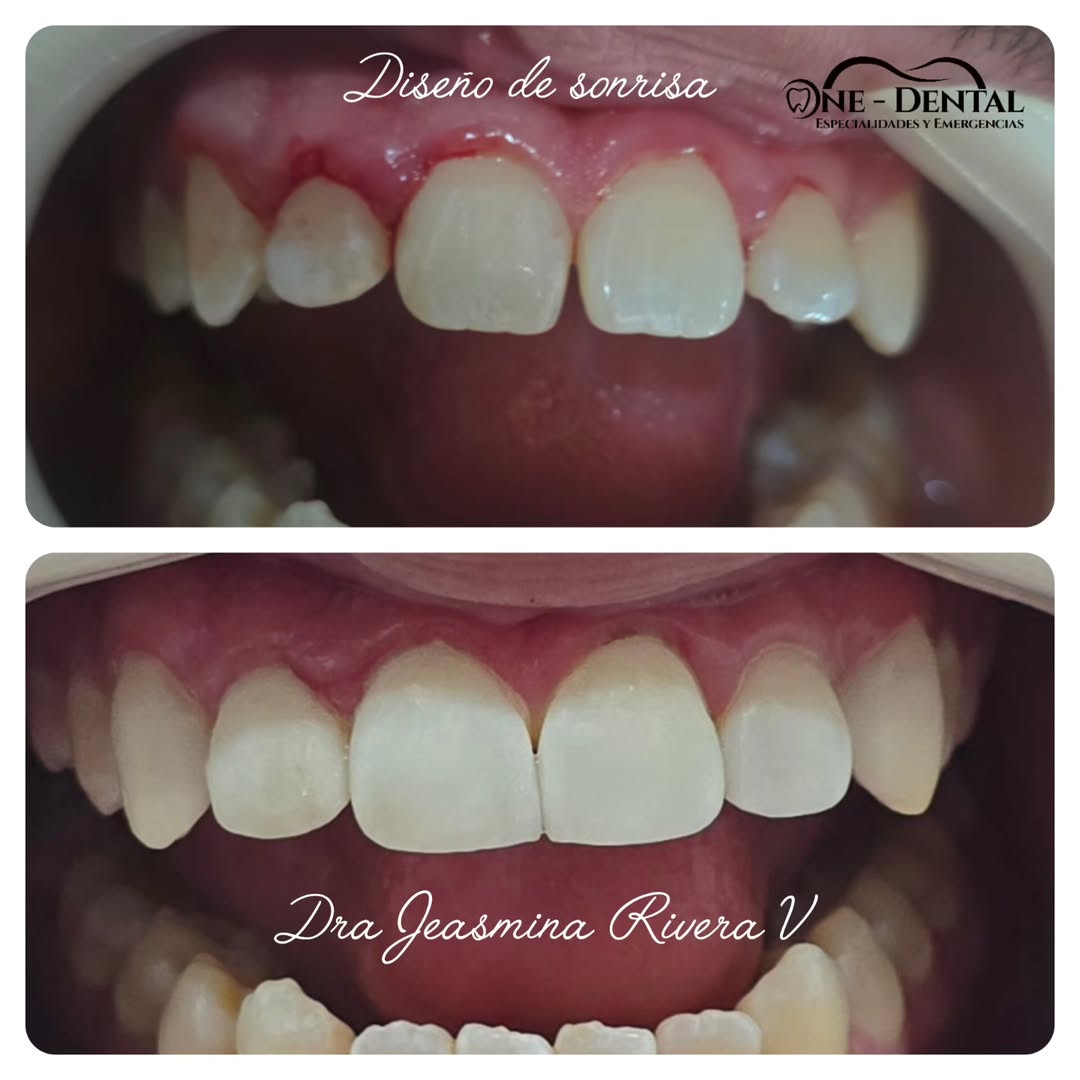 Diseño de sonrisa ONE DENTAL Managua