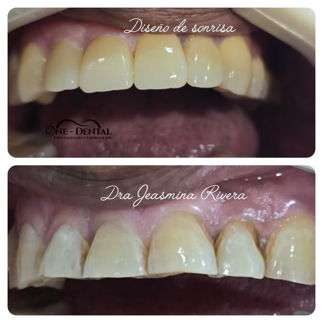 Diseño de sonrisa resultado real ONE DENTAL Managua