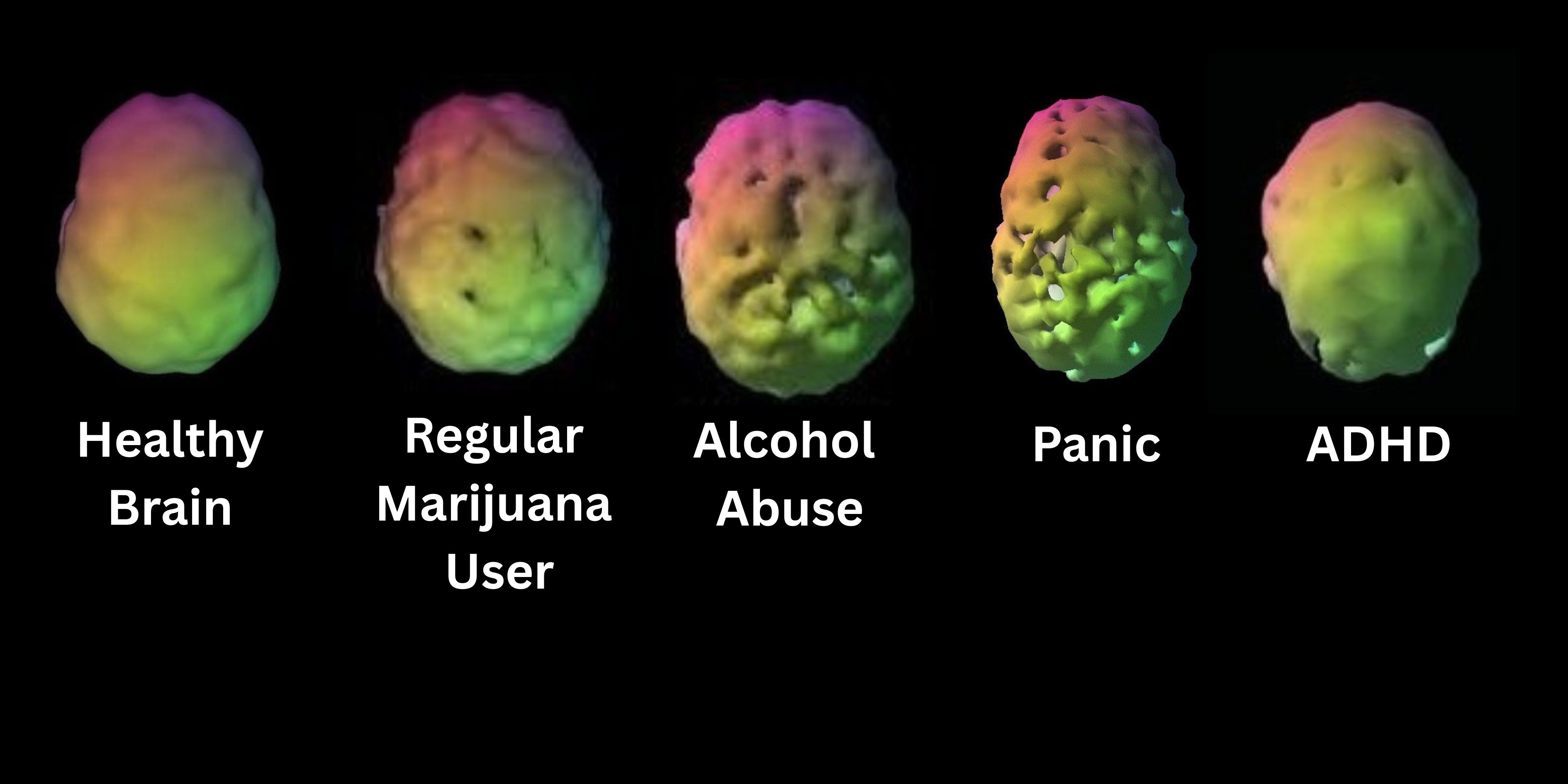 Dr. Daniel Amen SPECT brain scans showing the effects of addiction and trauma on brain activity