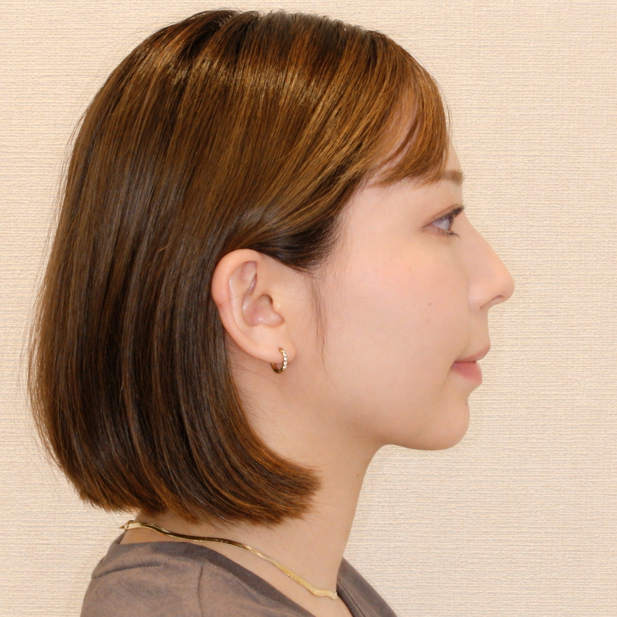 SmarteeGS 治療後 横顔