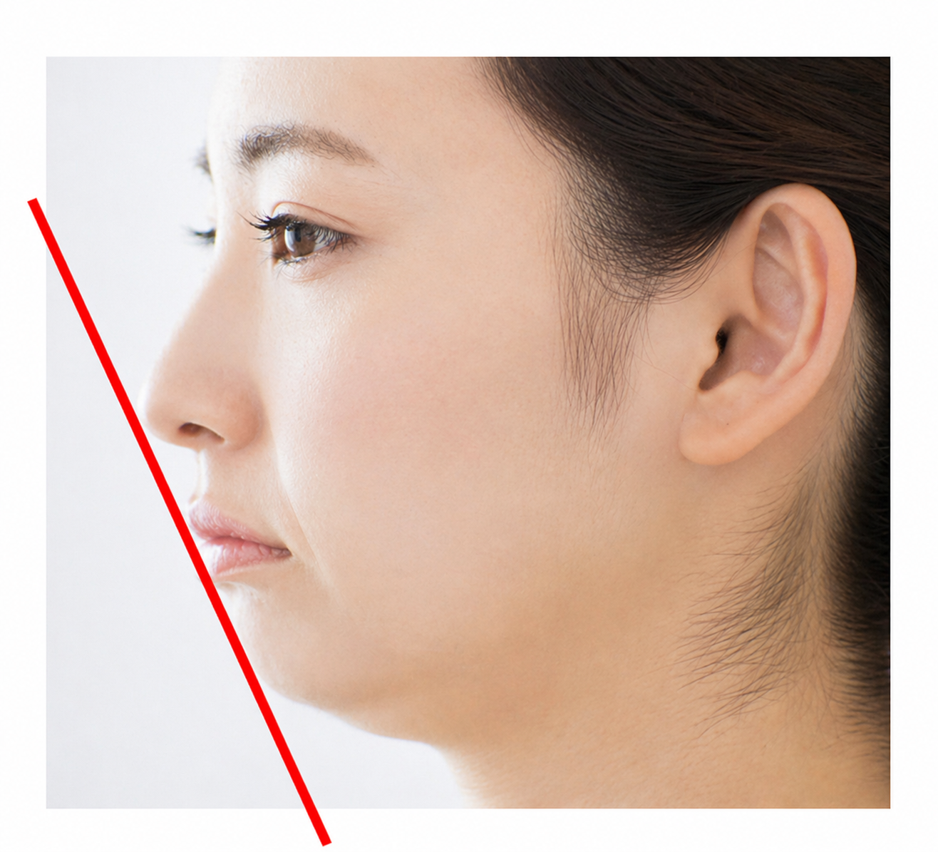 ① 抜歯 ワイヤー矯正