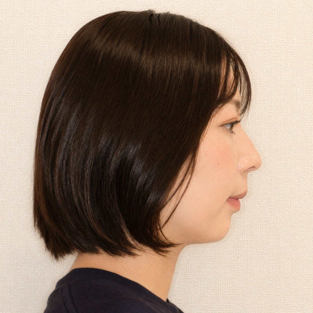 SmarteeGS 治療前 横顔