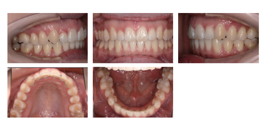 咬合再建(フェーズ2)
