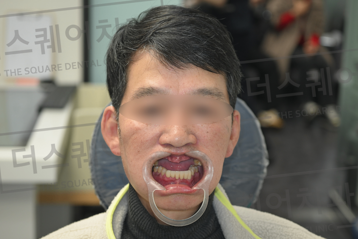 症例 01 治療前