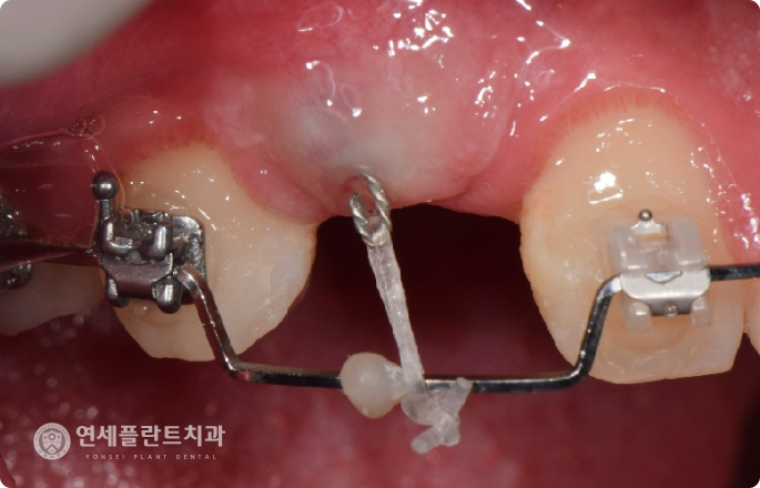 영구치 맹출 장애
