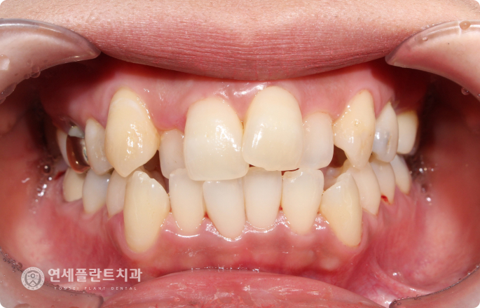 악궁 확장기
