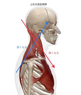 上位交差症候群による首こり・肩こり・深層筋の弱さを示す姿勢改善図解|ストレッチルーネ