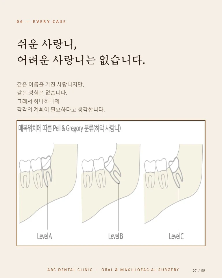 쉬운 사랑니, 어려운 사랑니는 없습니다