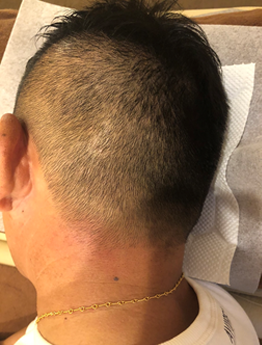 半年後、頭痛の症状で来院された時の写真がこちら。ほぼ完ぺきに治って、白髪も消えていました。