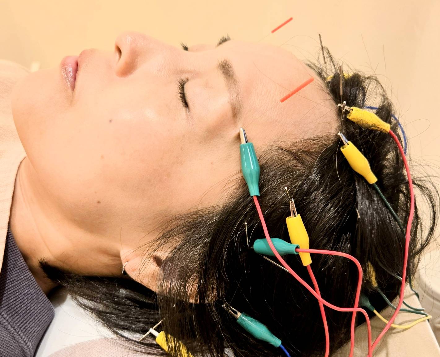 当院の鍼治療について