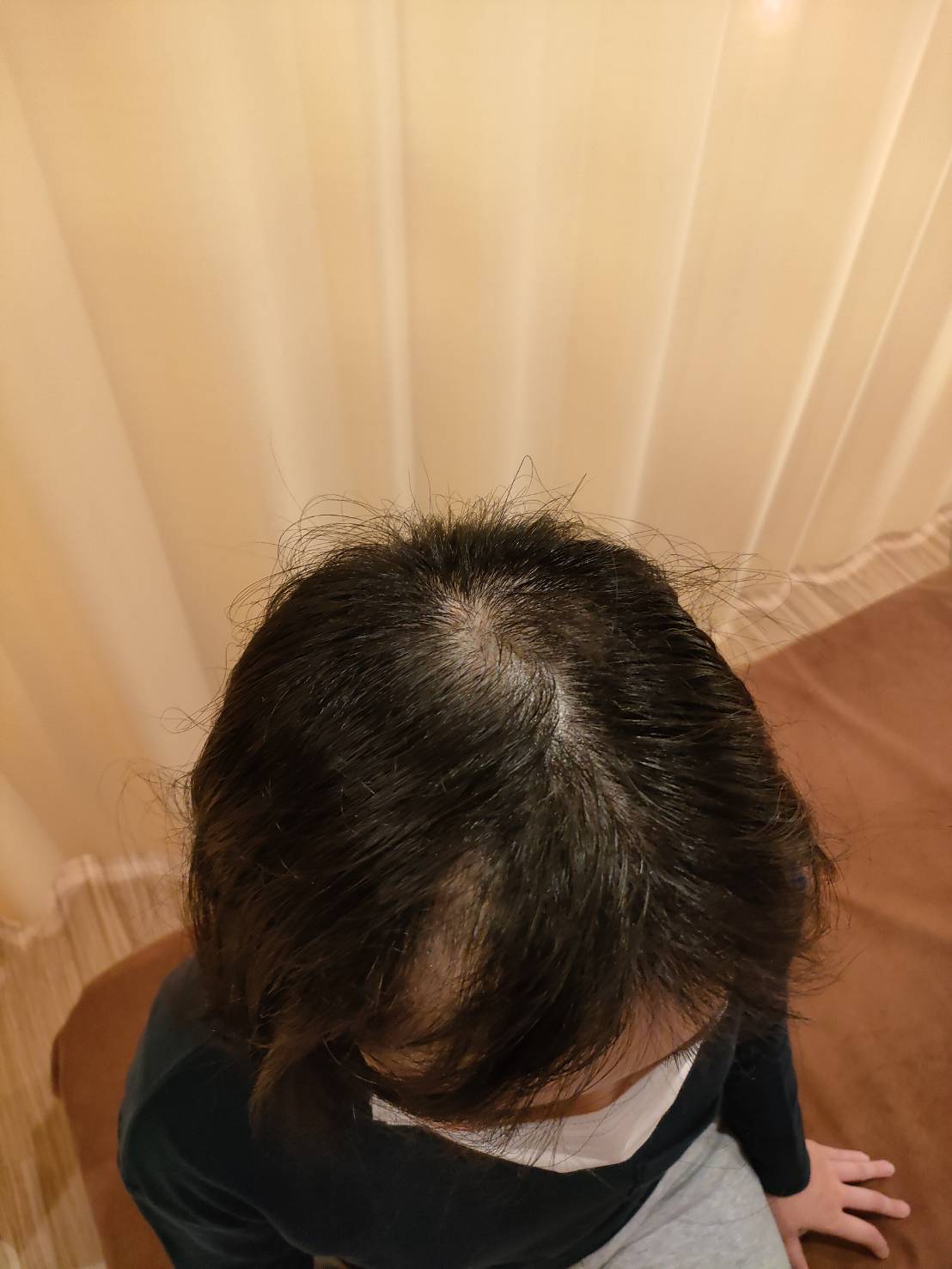 治療開始2ヶ月で抜け毛量がかなり減少。4ヶ月で下の写真の状態まで回復。