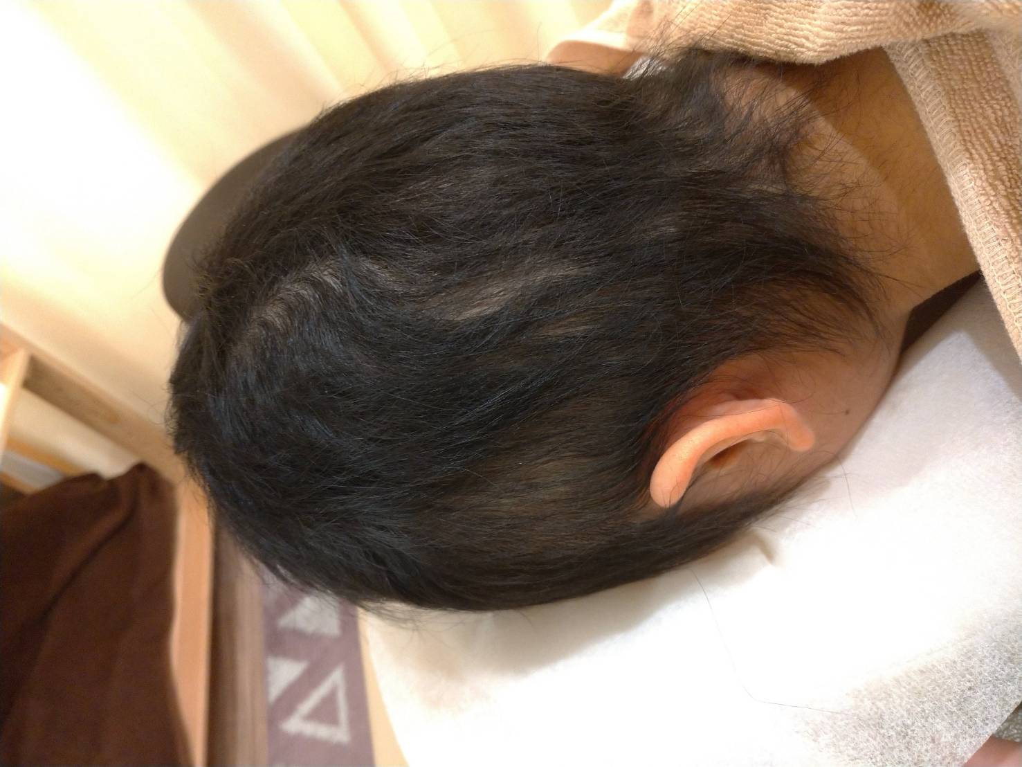 約半年鍼灸で治療し50%程度改善。