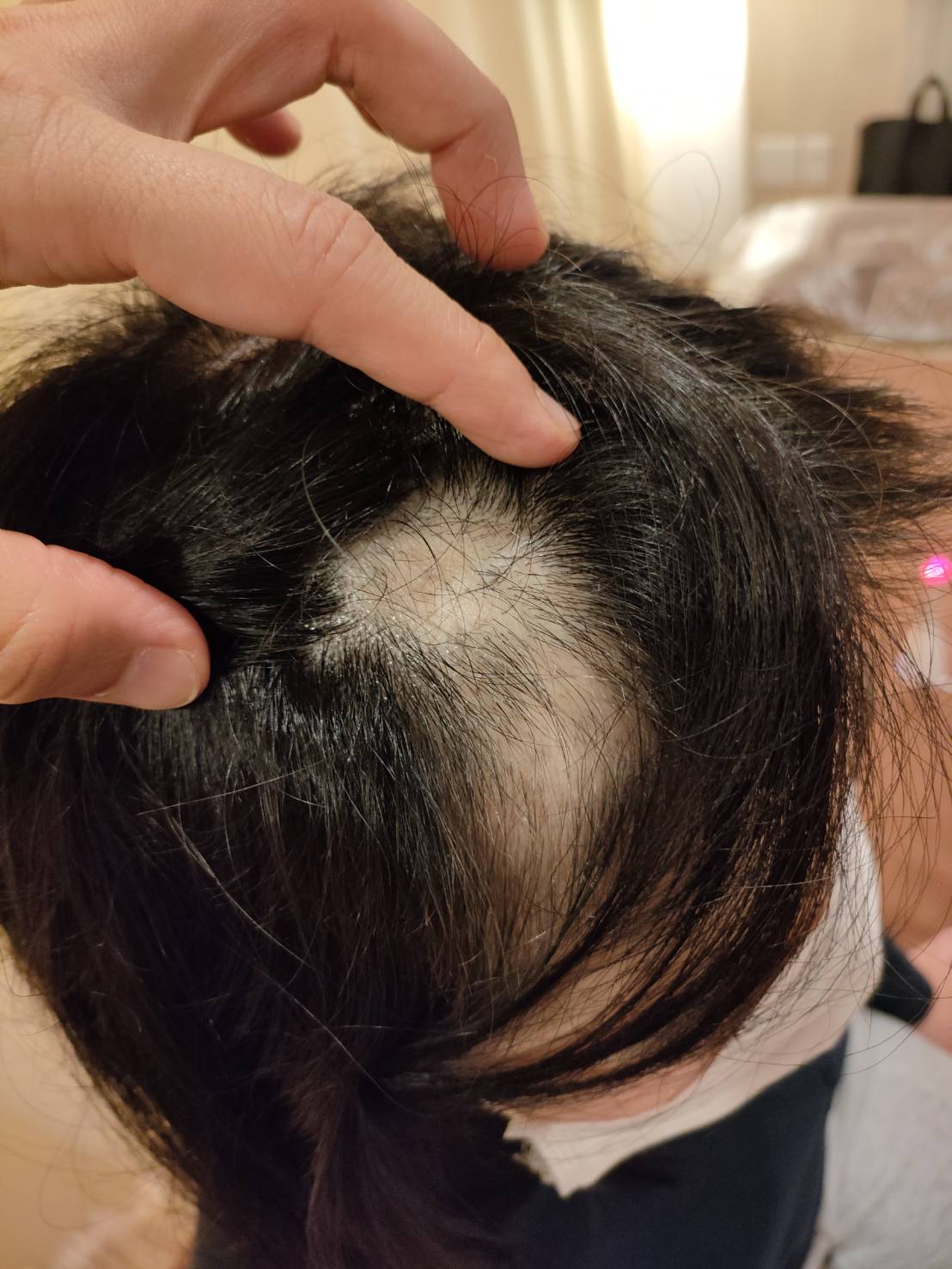 初診時の写真 右前頭部と頭頂部に大きな円形脱毛