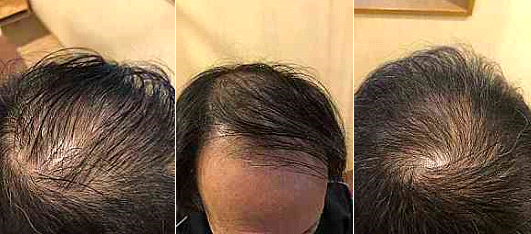 3か月後の写真です。毛量は少し増え毛立ちも良くなり、見た目に改善がみられます。しかし発毛効果に限界があり、フサフサというわけにはいきません。また生え際の発毛は見られませんでした。