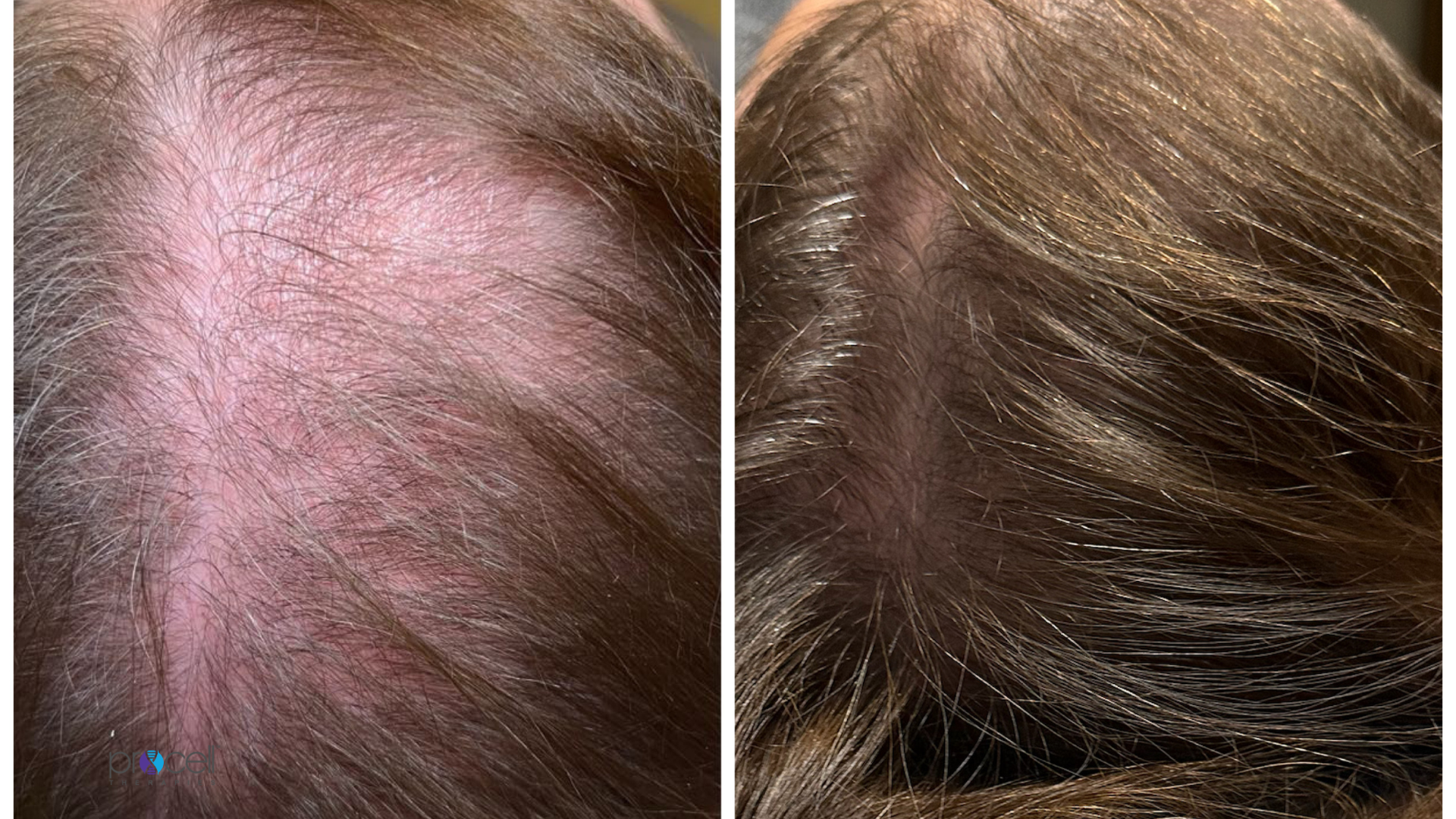 Hair restoration treatment