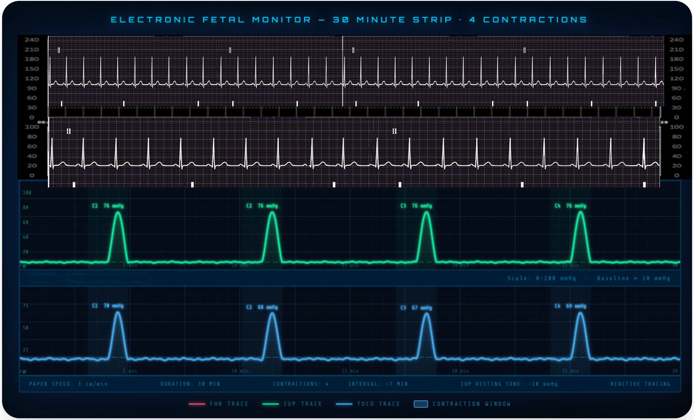 Electronic Fetal Monitor with balloon contraction data